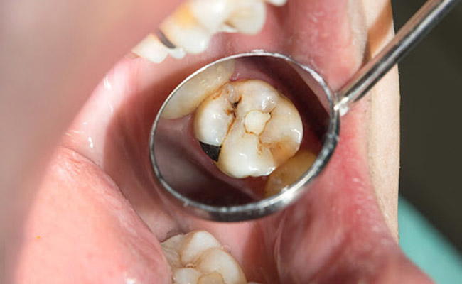 Tiểu đường có thể gây biến chứng về răng miệng