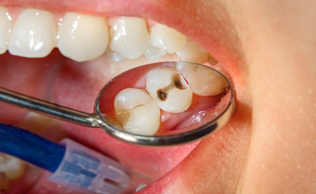 Vải chữa răng sâu hiệu quả